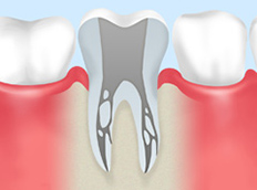 重度の虫歯を歯の根から治す治療です