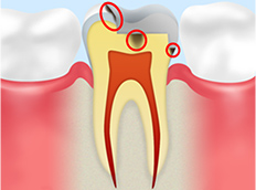 「2次的虫歯」をご存知ですか？